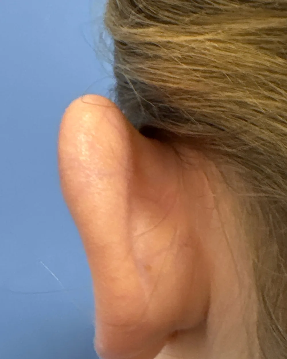 Behind the left ear, before surgery