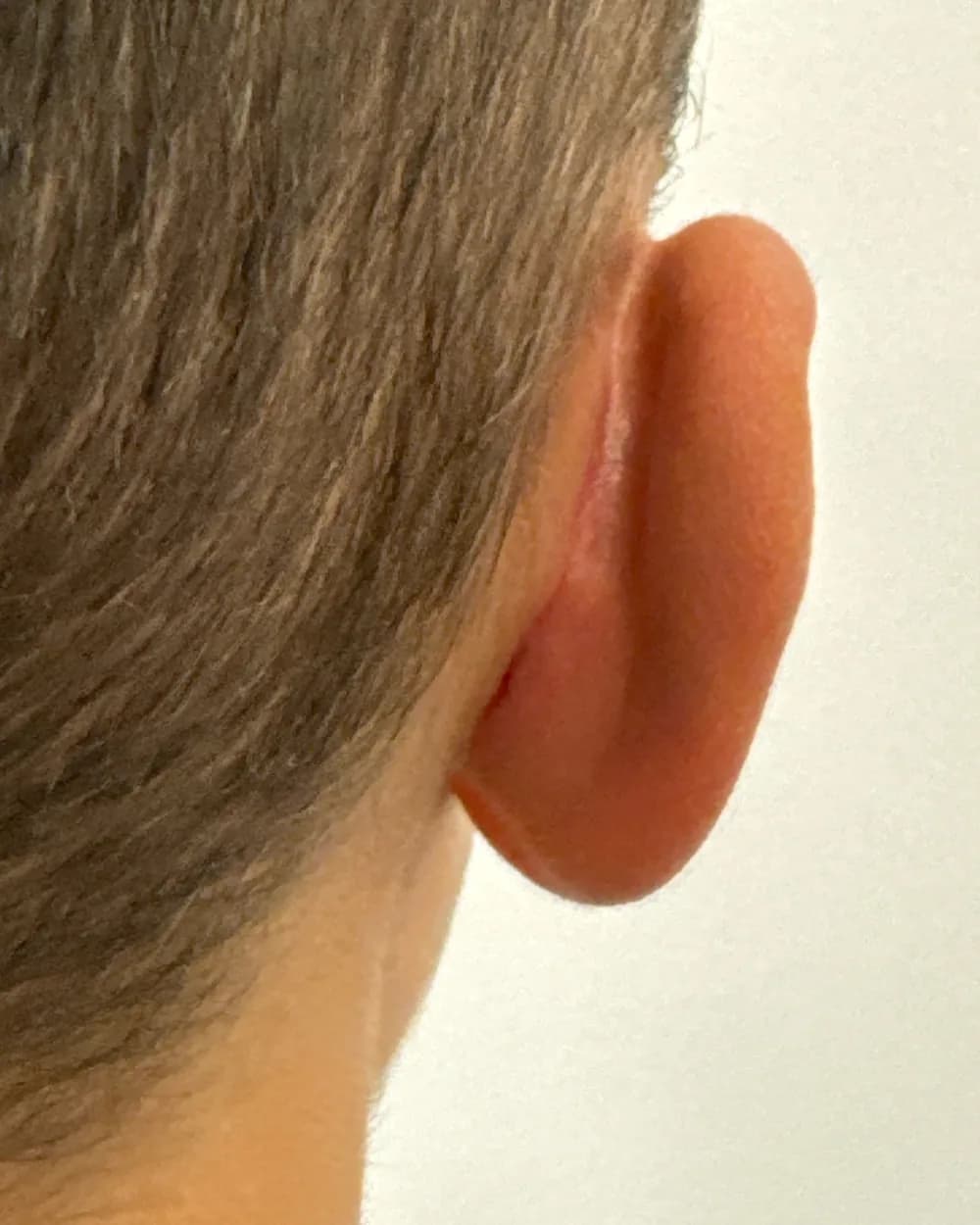 Behind the right ear, after surgery