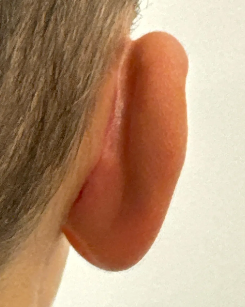 Behind the right ear, after surgery