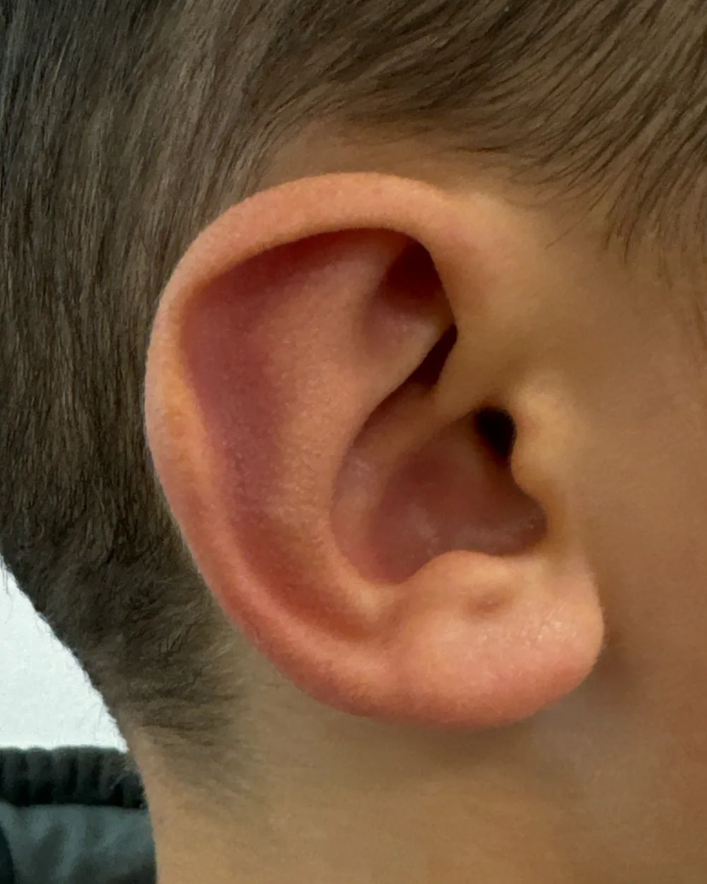 Right ear, from the side, after surgery