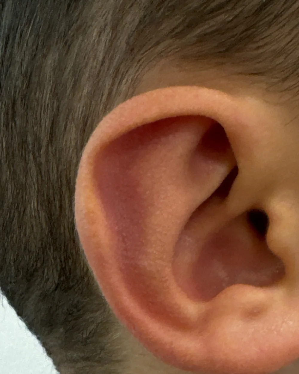 Right ear, from the side, after surgery