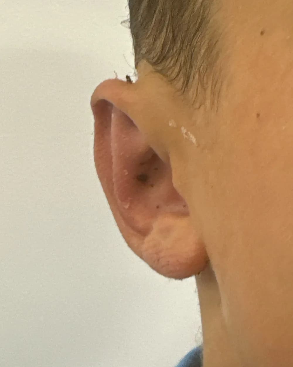 Right ear, from the front, after surgery