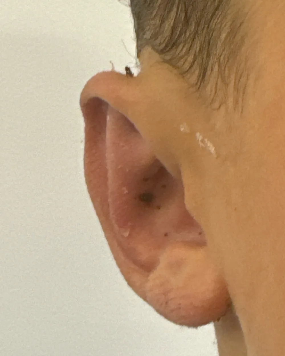 Right ear, from the front, after surgery