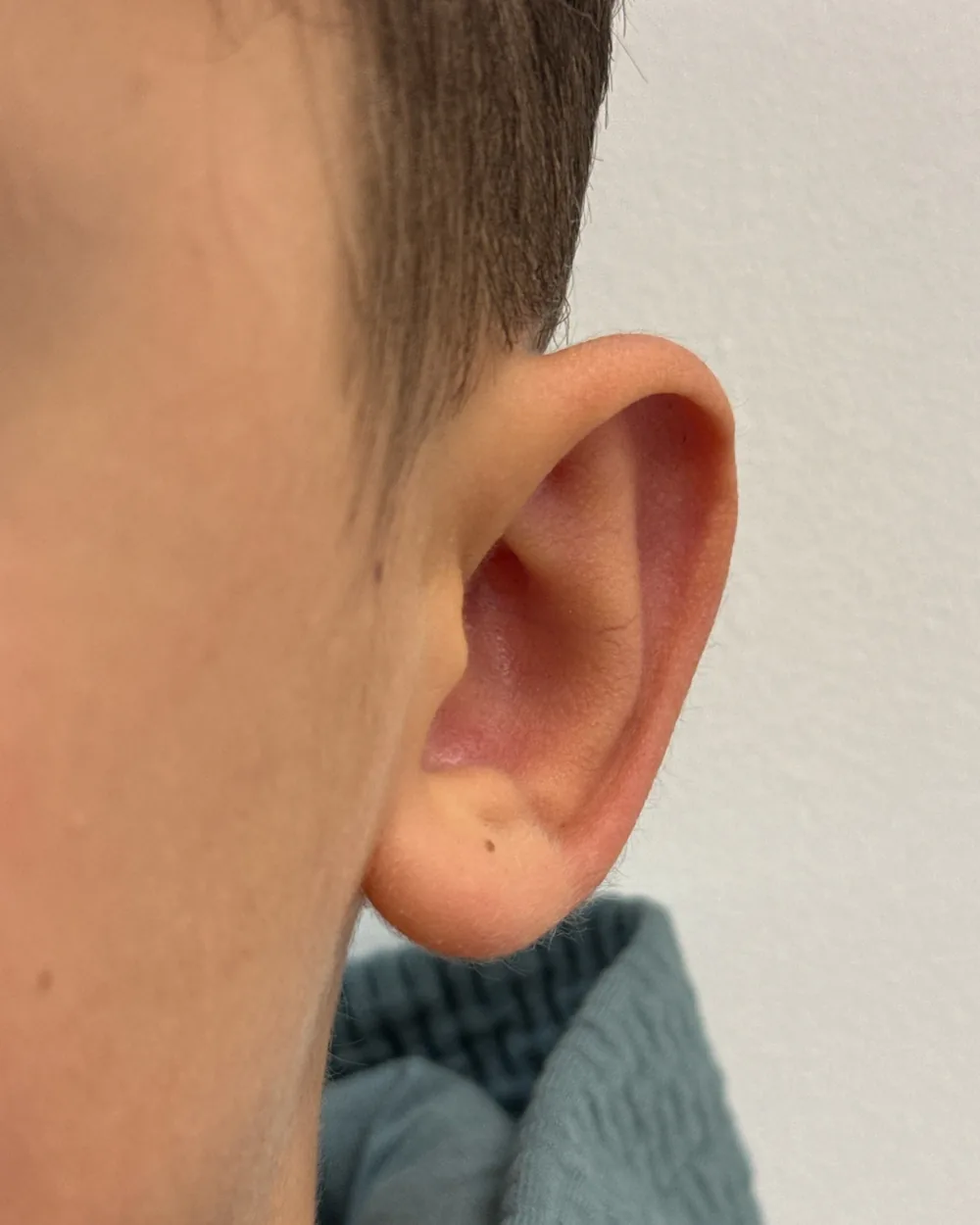 Left ear, from the front, after surgery