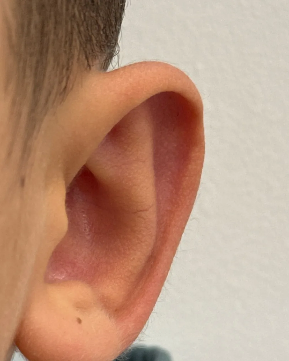 Left ear, from the front, after surgery