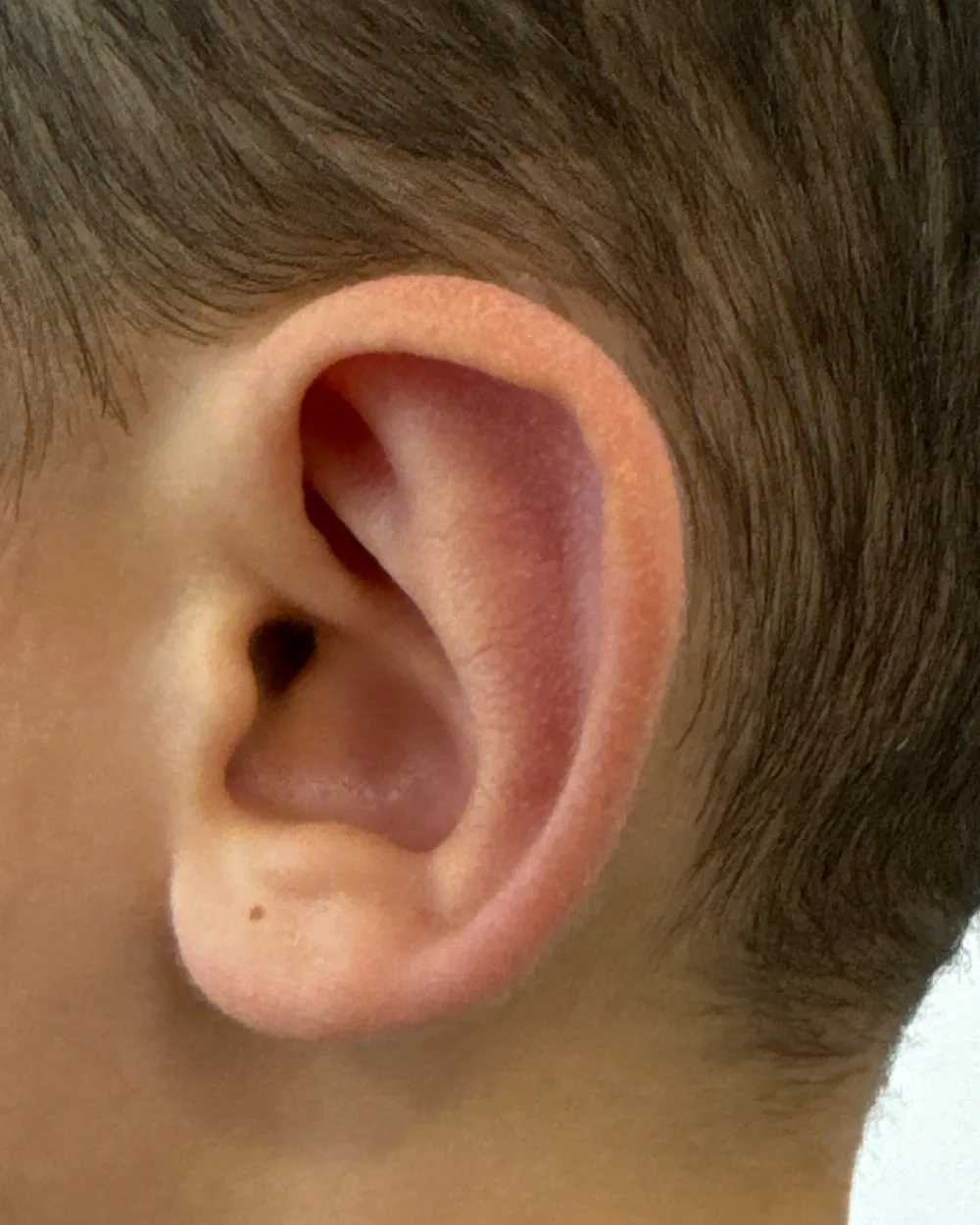 Left ear, from the side, after surgery