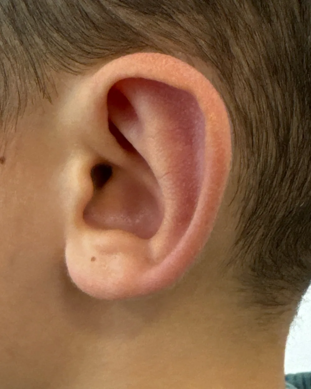 Left ear, from the side, after surgery