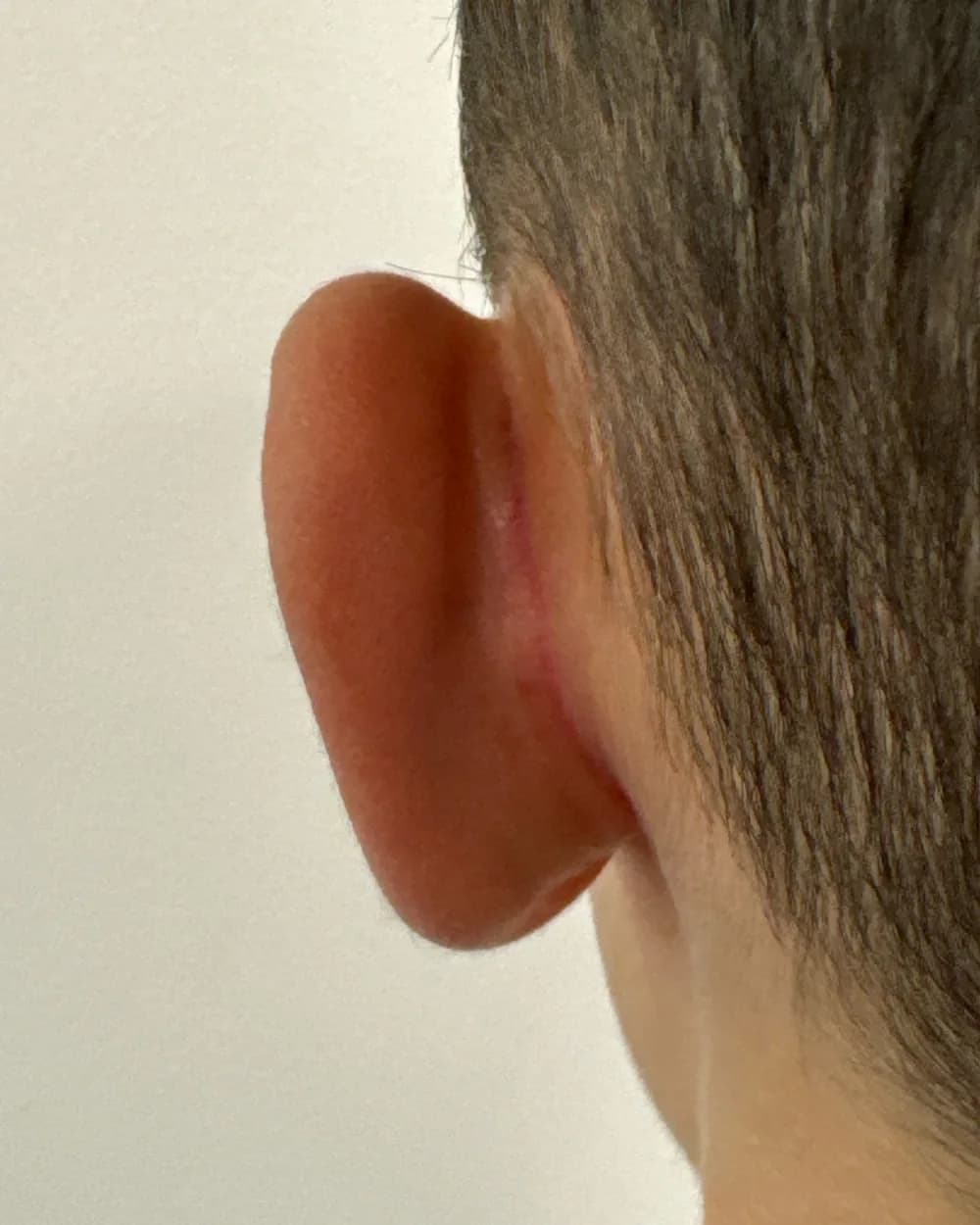 Behind the left ear, after surgery