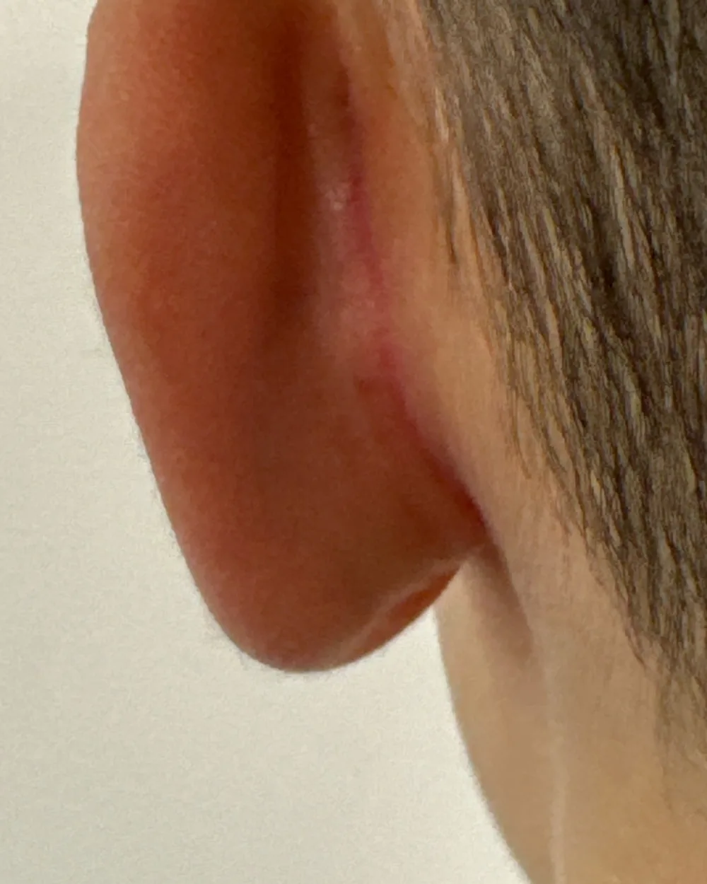 Behind the left ear, after surgery