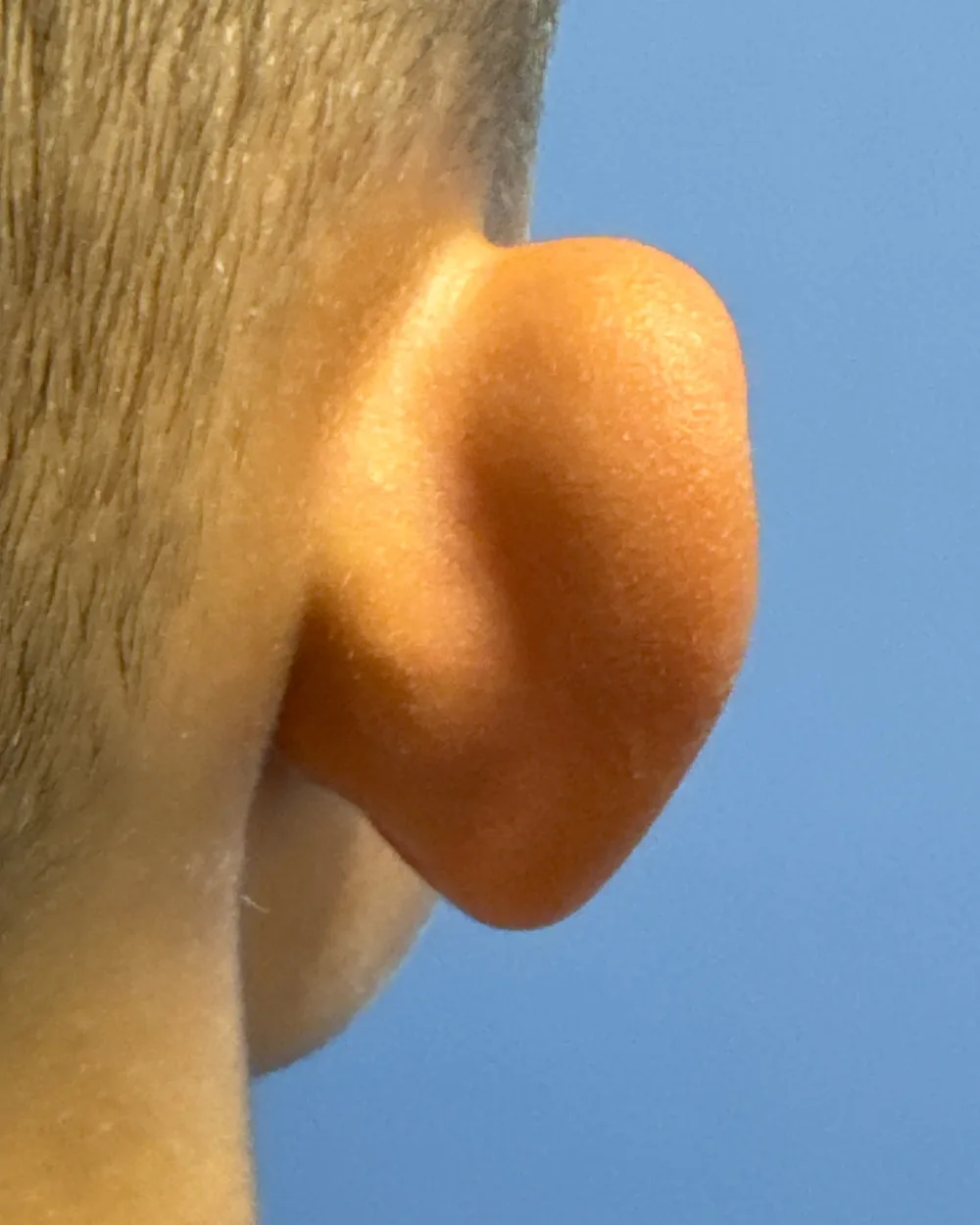 Behind the right ear, before surgery