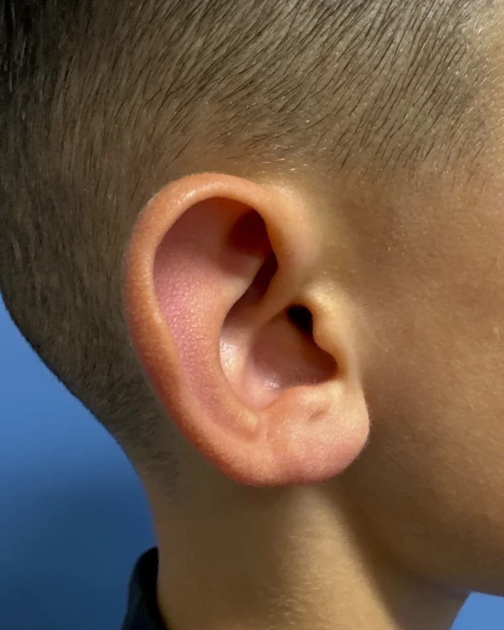 Right ear, from the side, before surgery