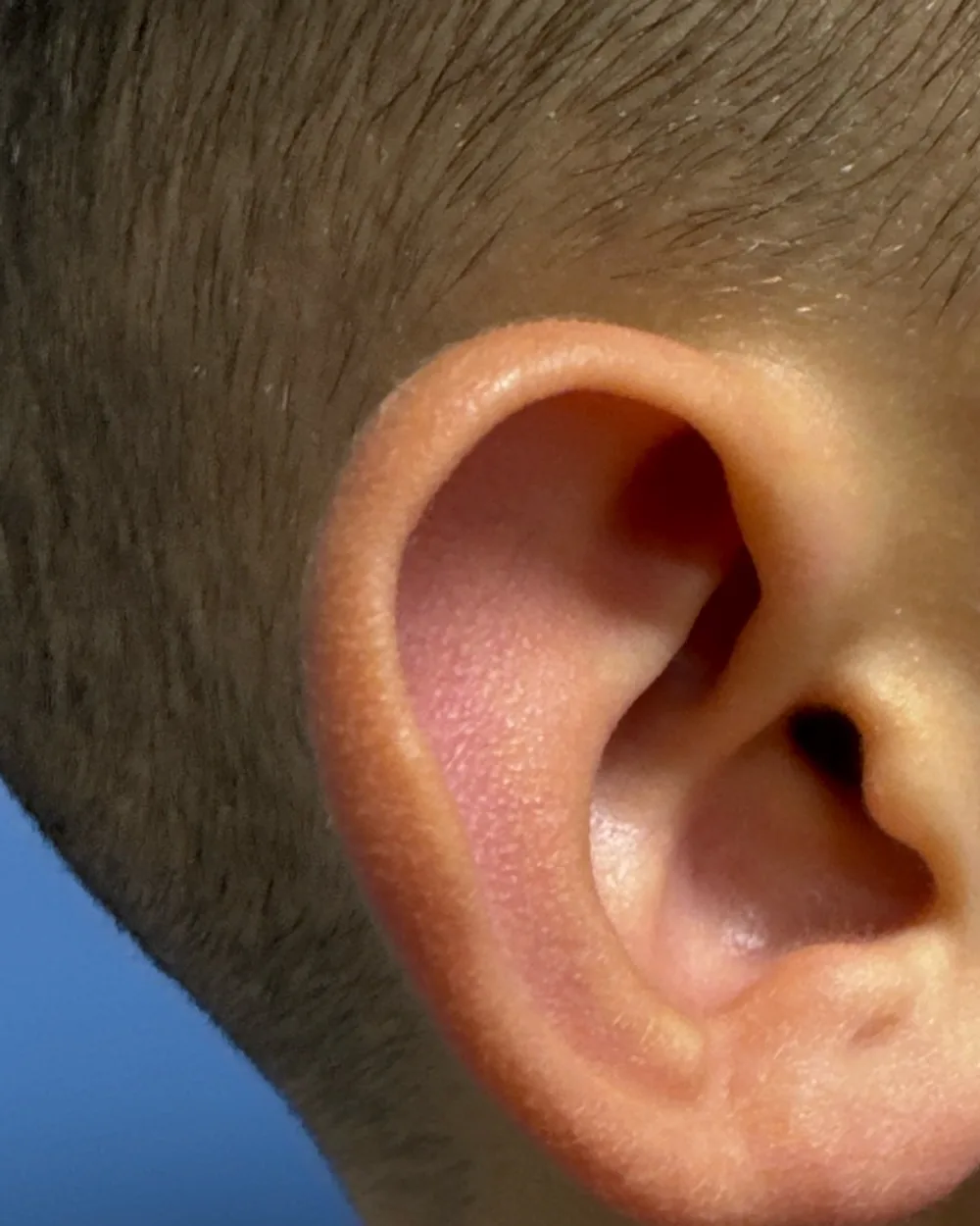 Right ear, from the side, before surgery