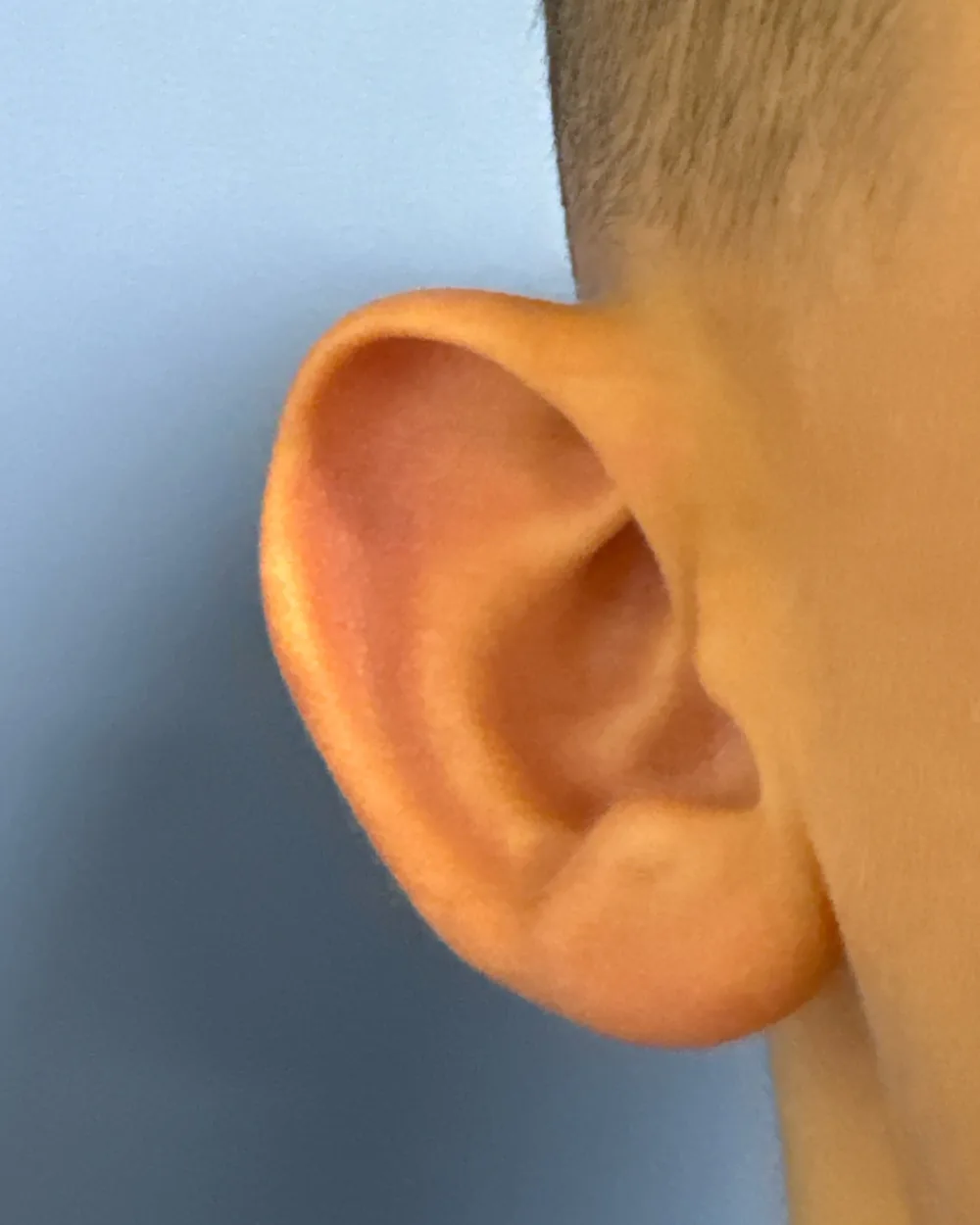 Right ear, from the front, before surgery
