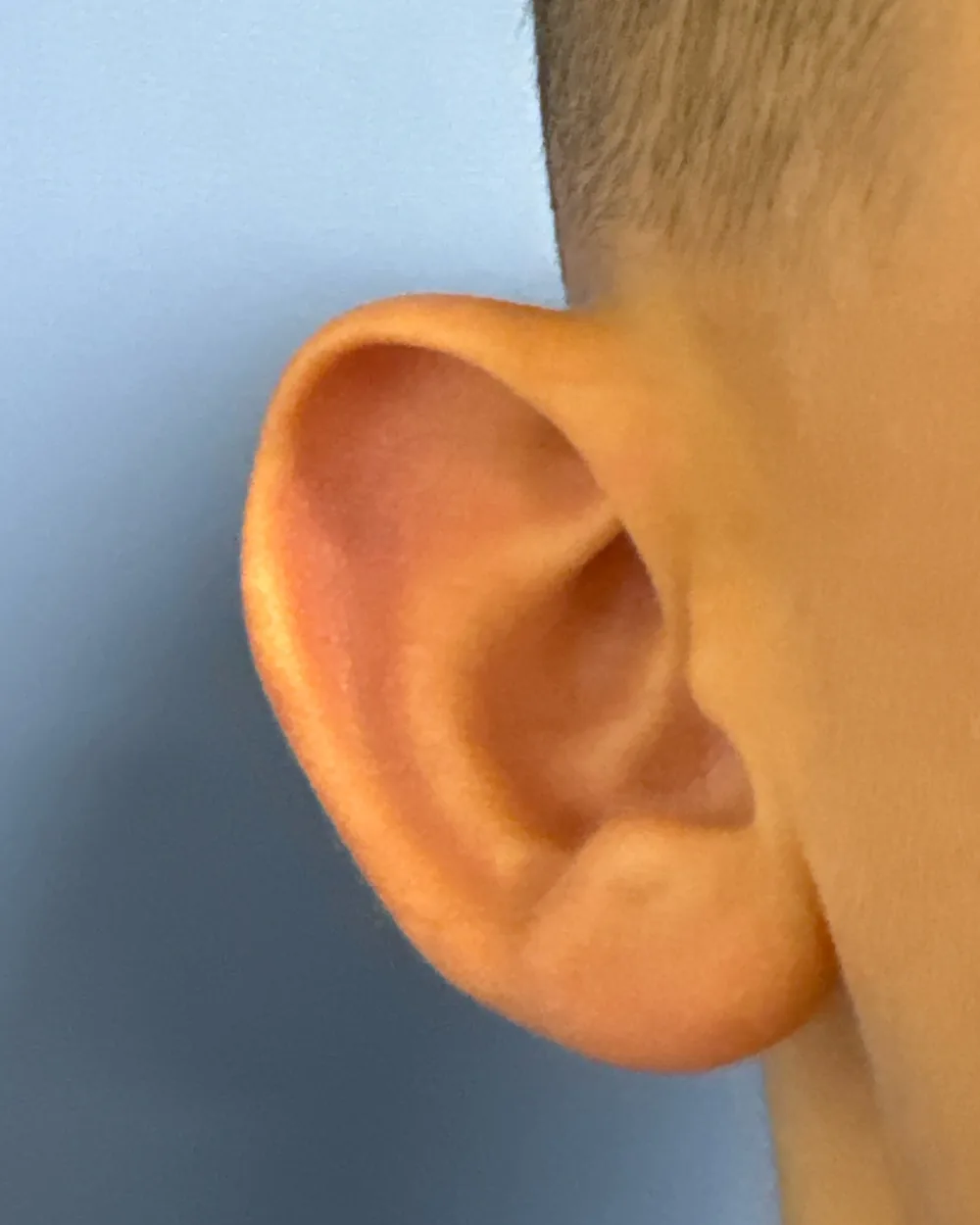 Right ear, from the front, before surgery