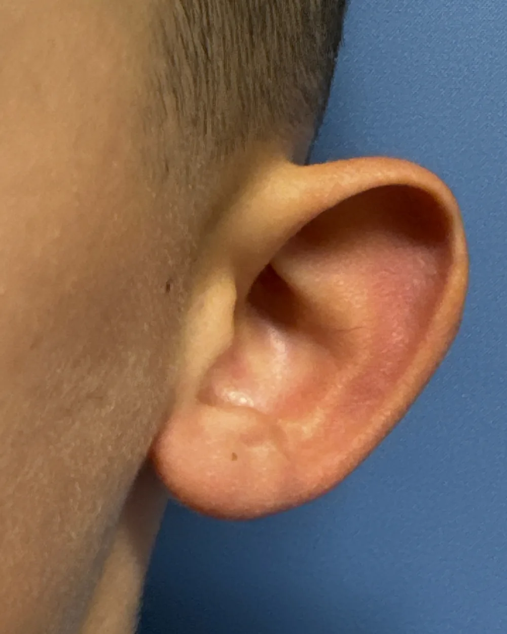 Left ear, from the front, before surgery