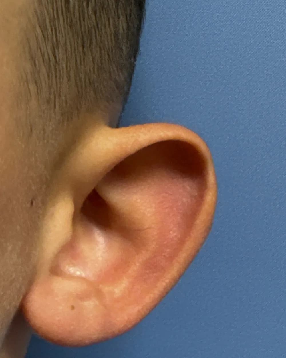 Left ear, from the front, before surgery