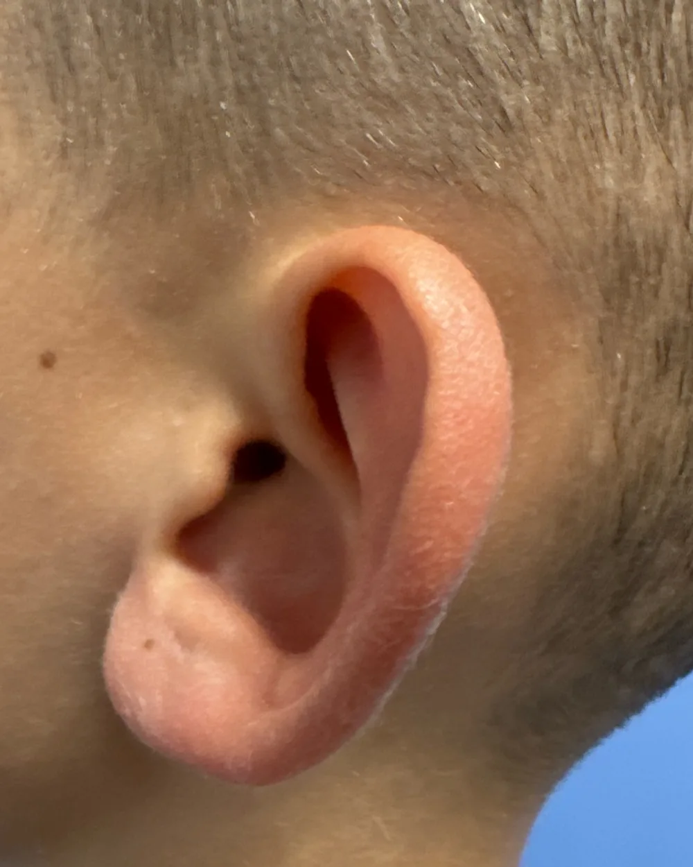 Left ear, from the side, before surgery