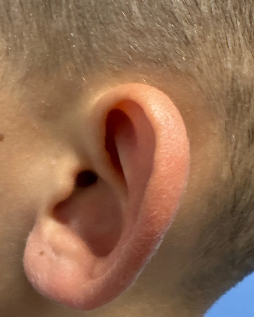 Left ear, from the side, before surgery