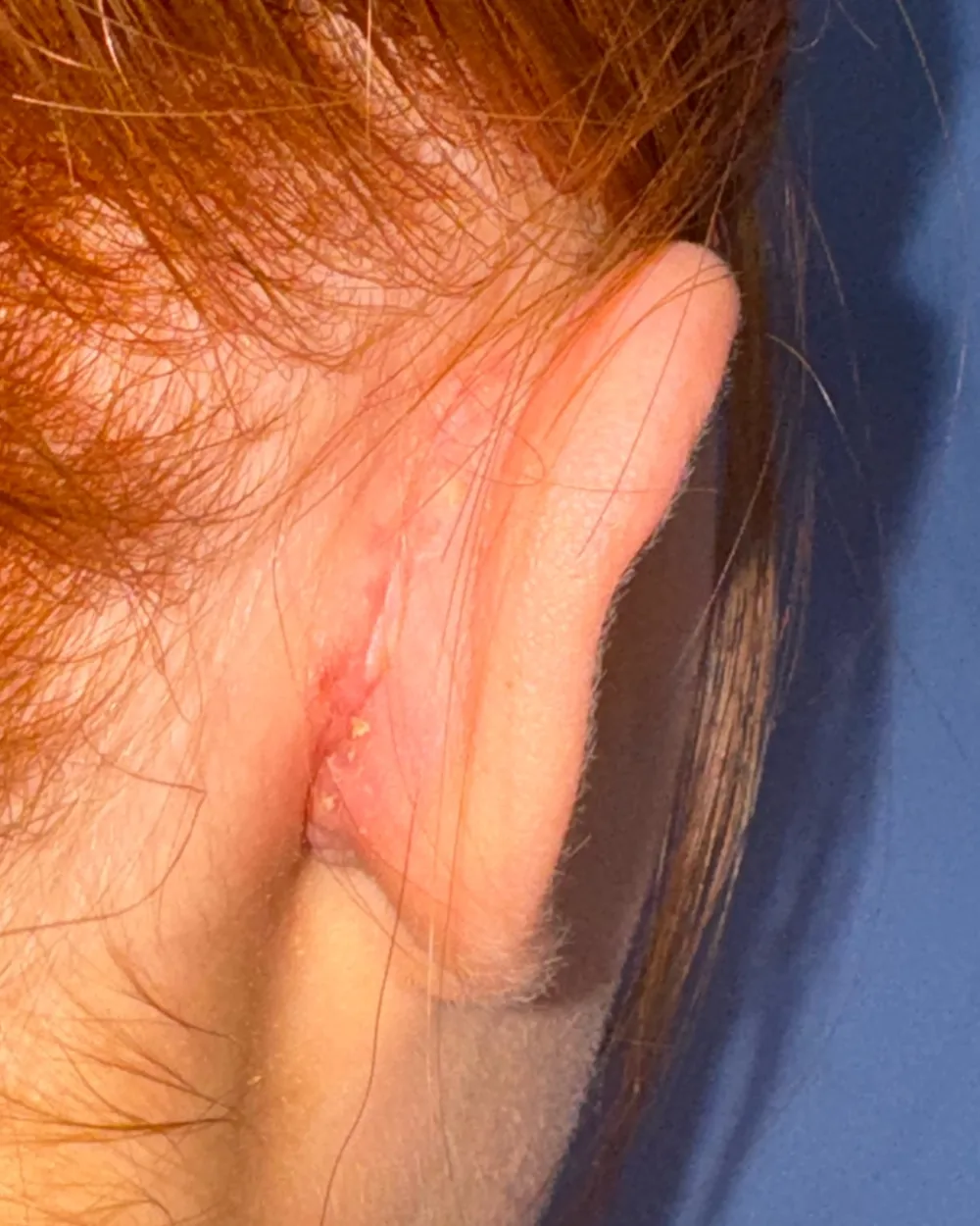 Behind the right ear, after surgery