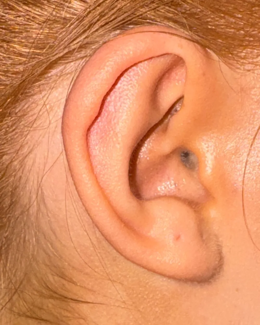 Right ear, from the side, after surgery