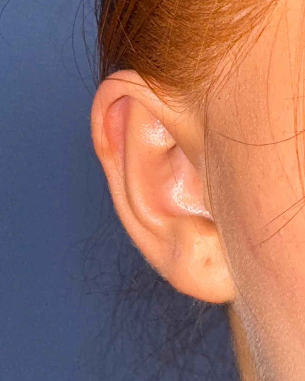 Right ear, from the front, after surgery