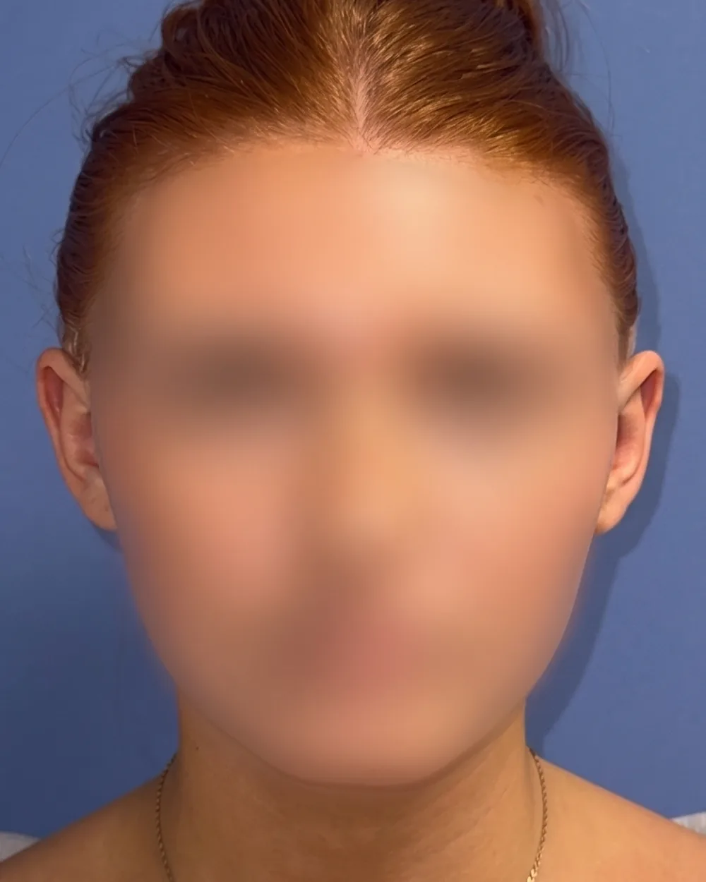 Face on, after surgery