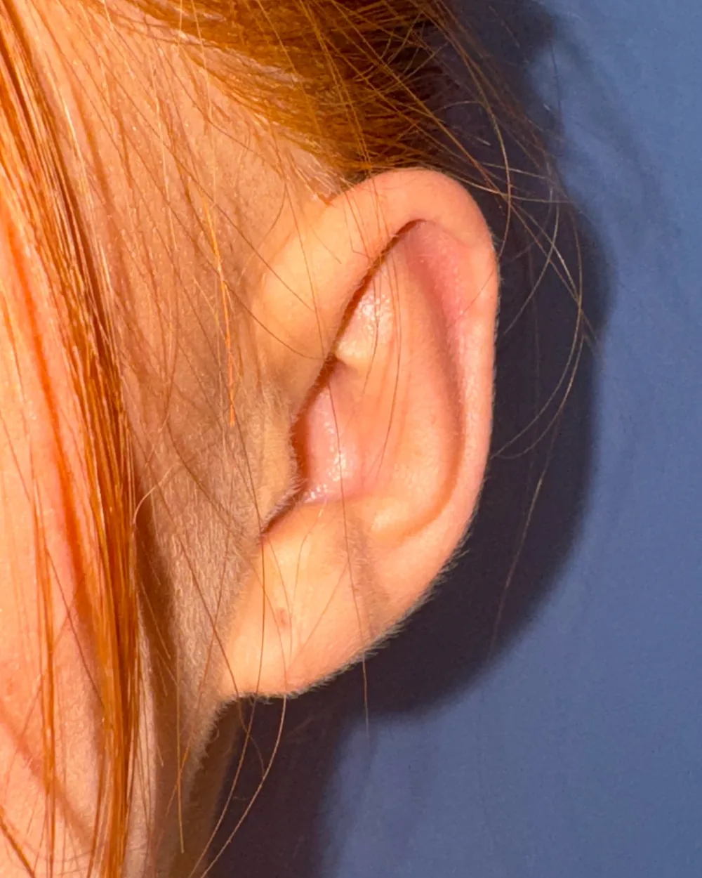 Left ear, from the front, after surgery