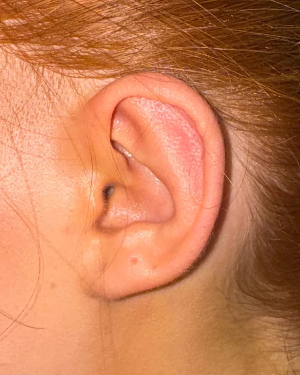 Left ear, from the side, after surgery