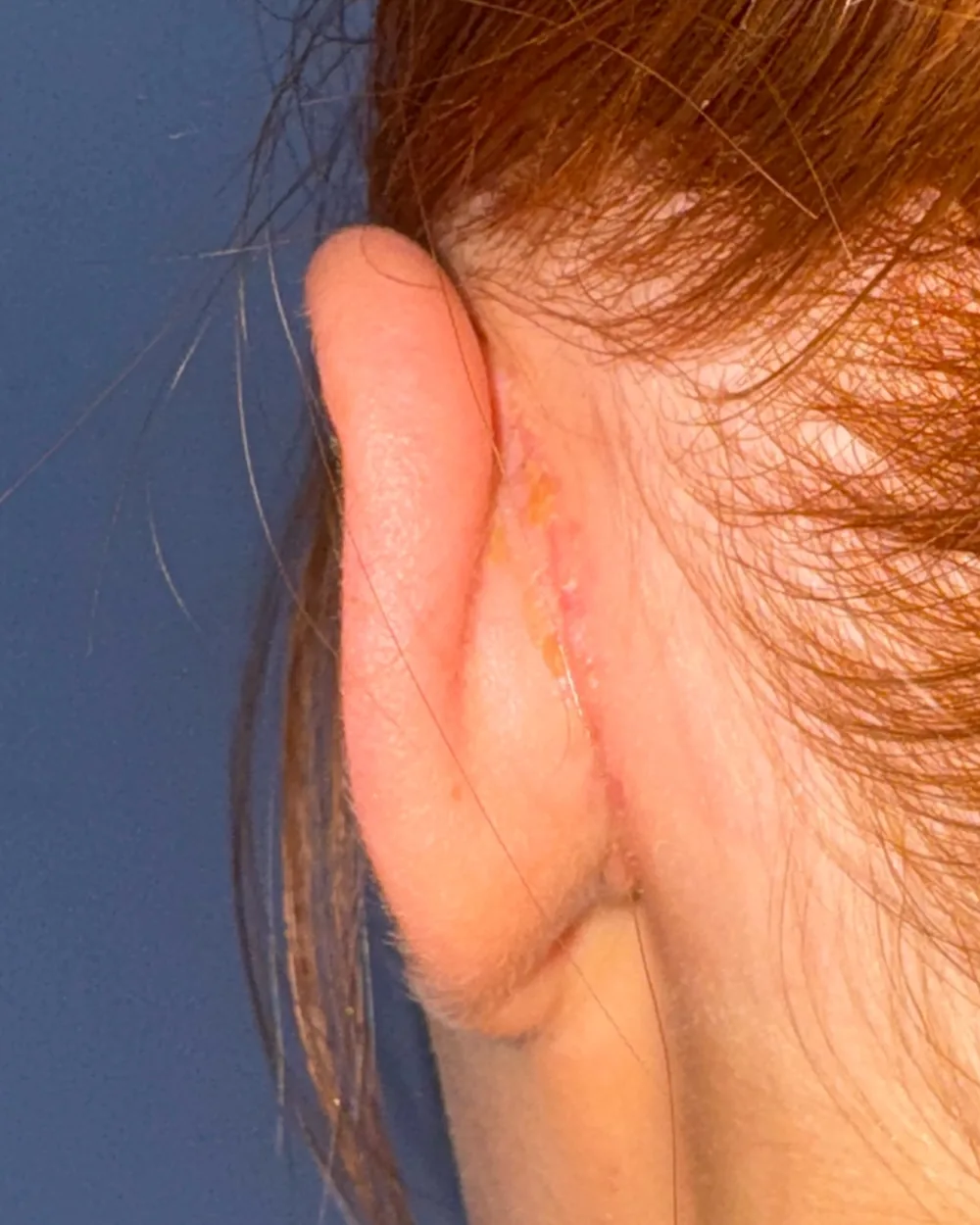 Behind the left ear, after surgery