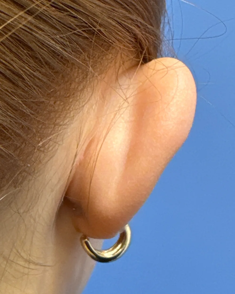 Behind the right ear, before surgery