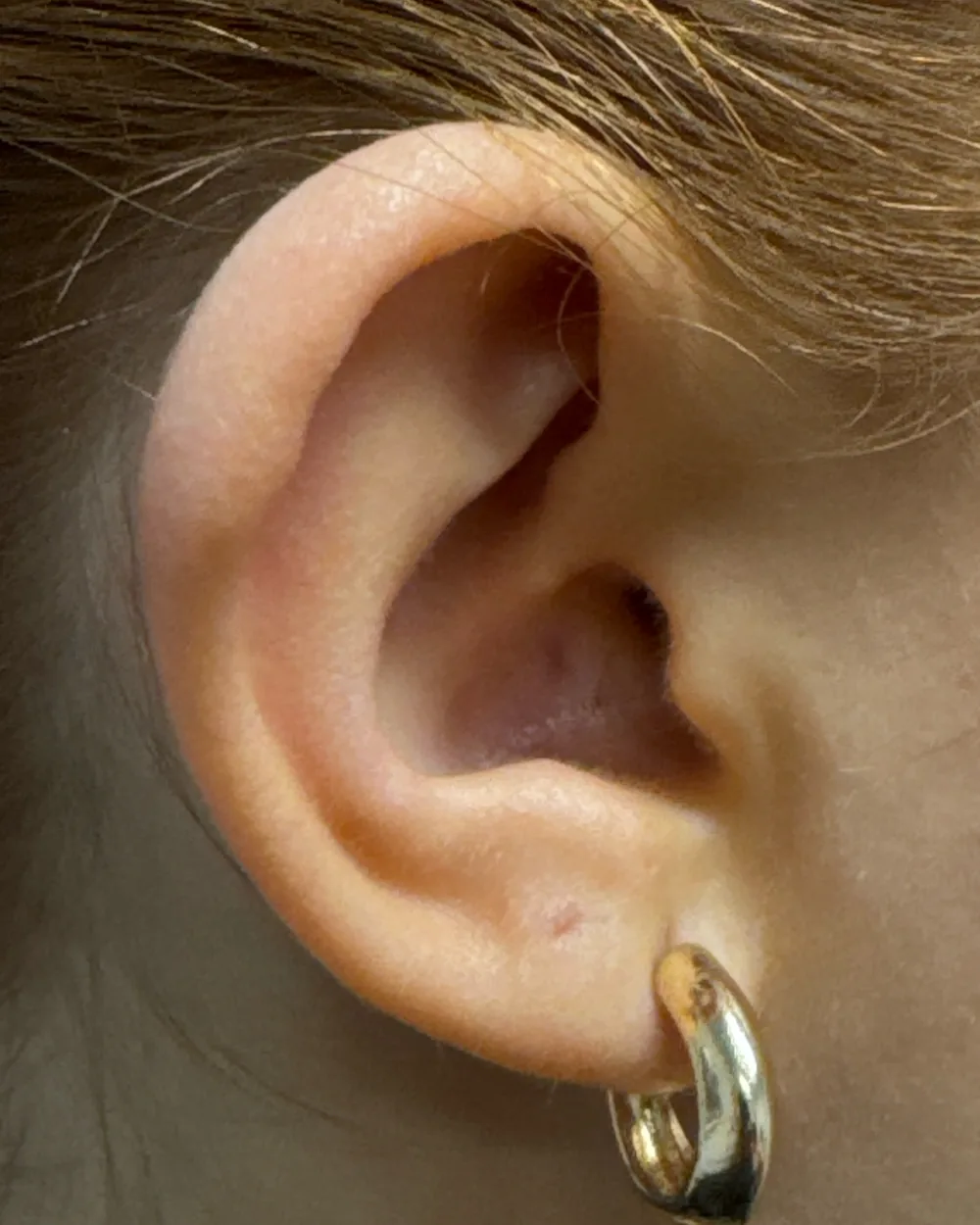 Right ear, from the side, before surgery
