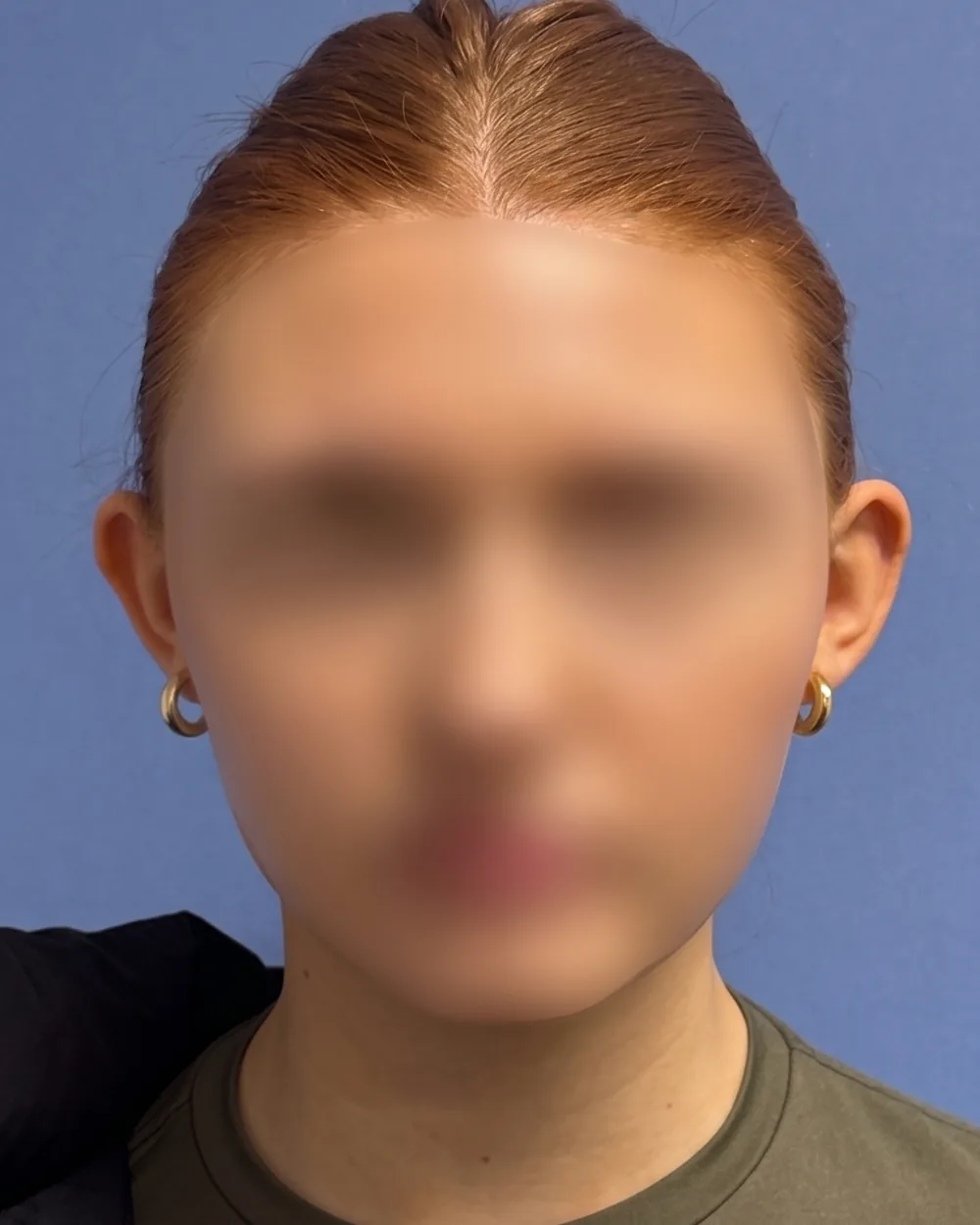 Face on, before surgery