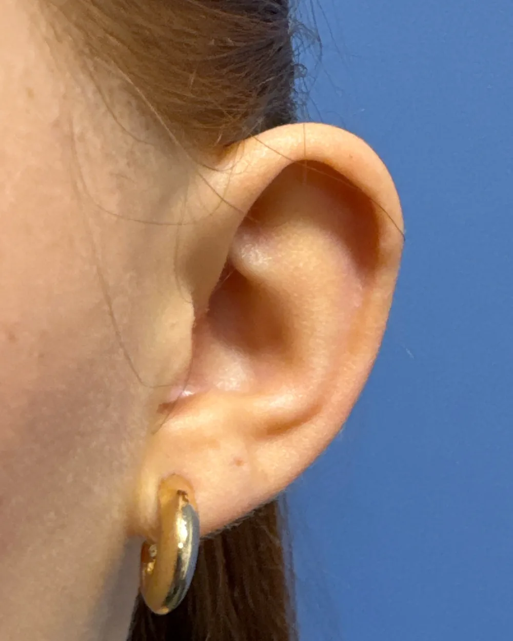 Left ear, from the front, before surgery