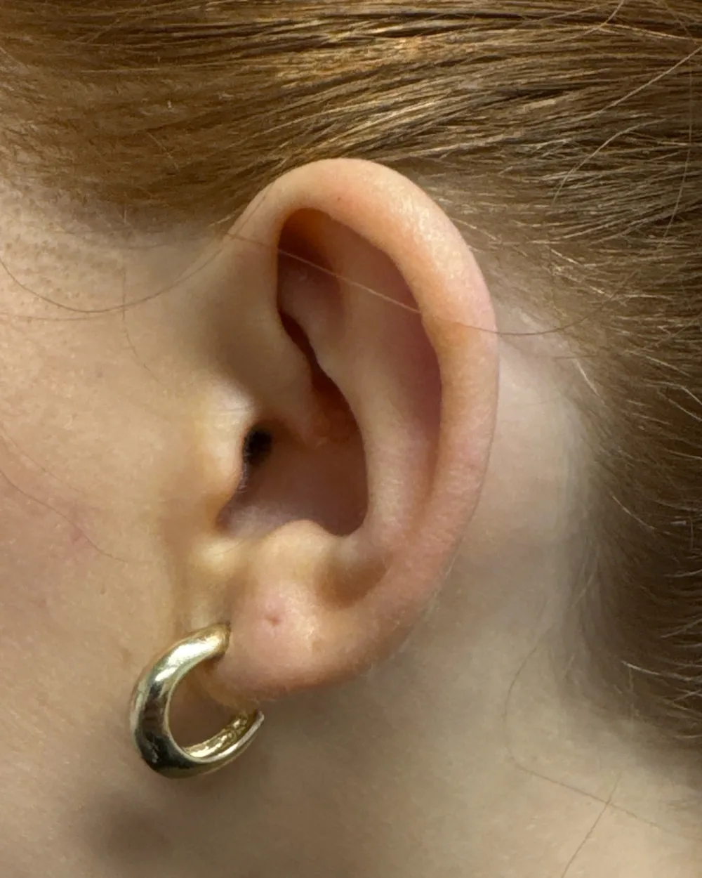 Left ear, from the side, before surgery
