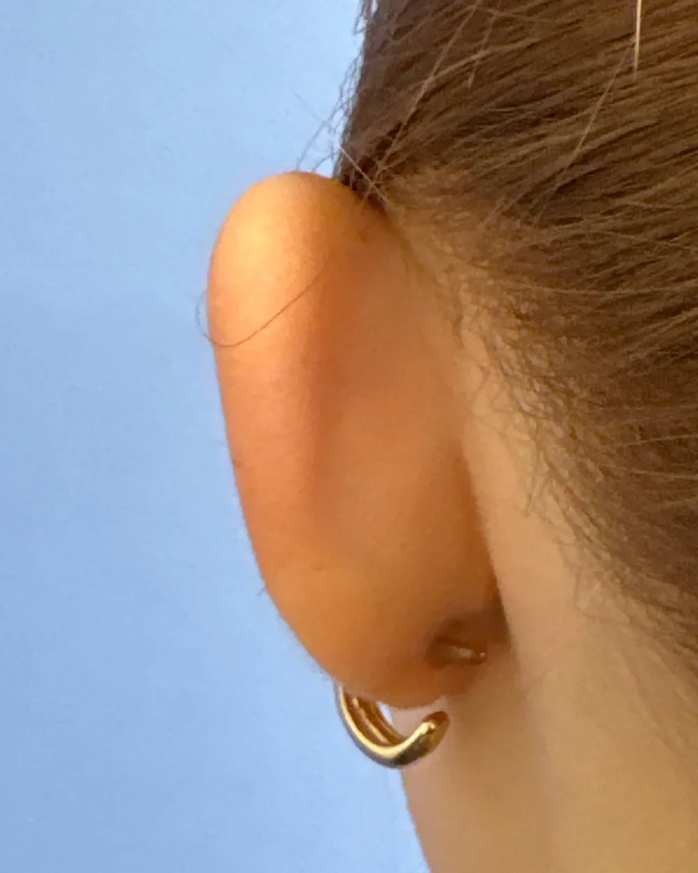 Behind the left ear, before surgery