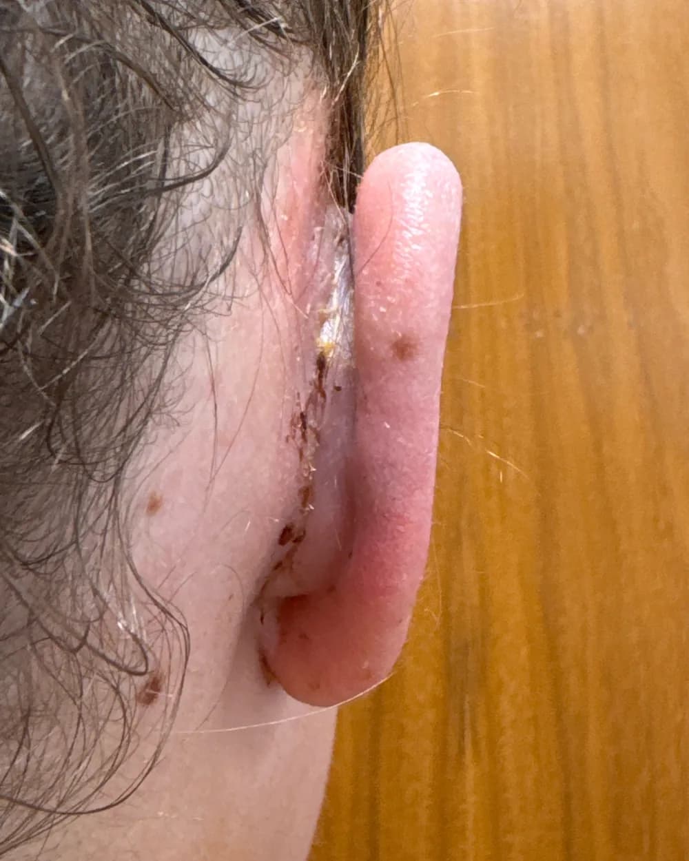 Behind the right ear, after surgery