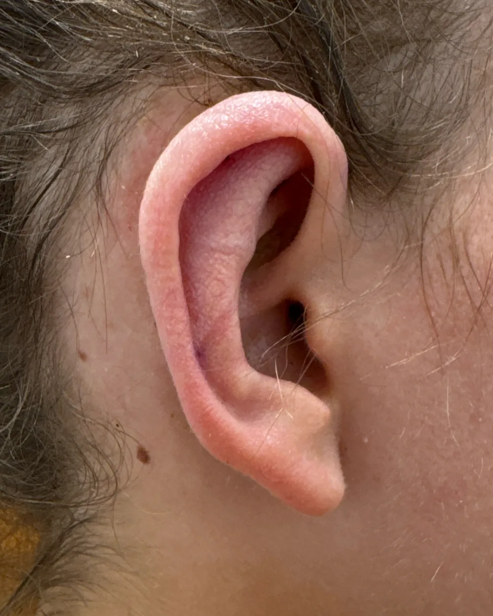 Right ear, from the side, after surgery