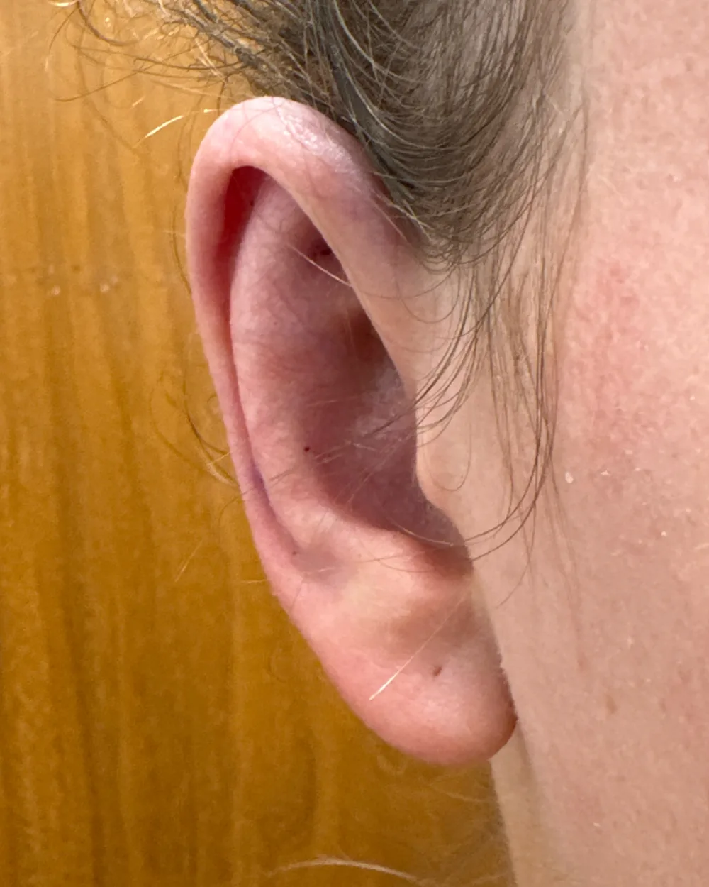 Right ear, from the front, after surgery