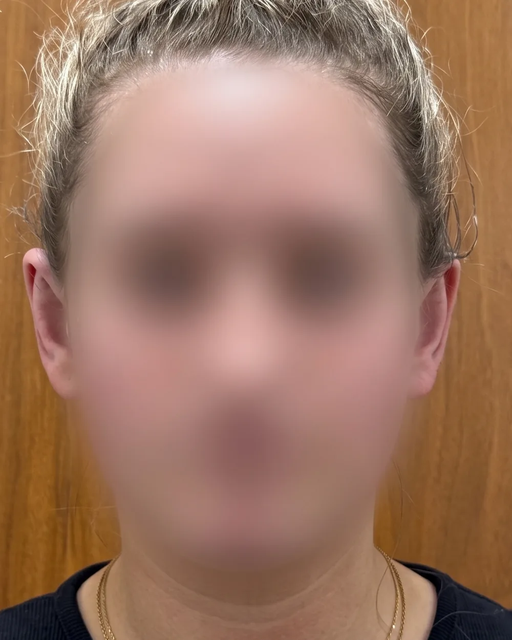 Face on, after surgery