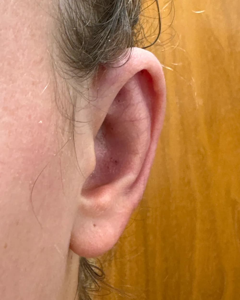 Left ear, from the front, after surgery
