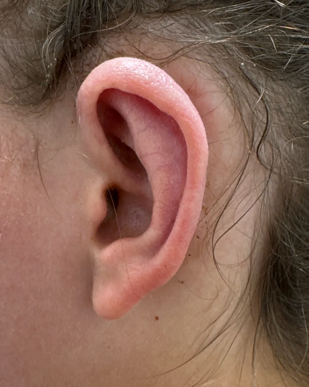 Left ear, from the side, after surgery