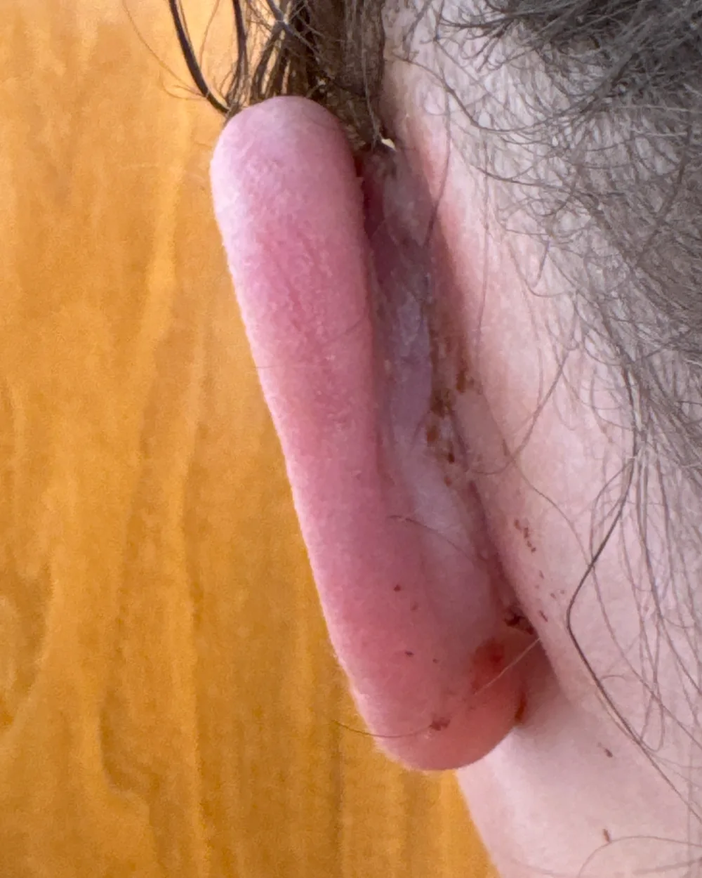 Behind the left ear, after surgery