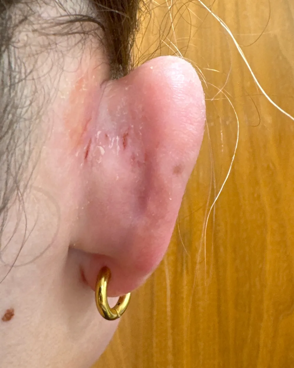 Behind the right ear, before surgery
