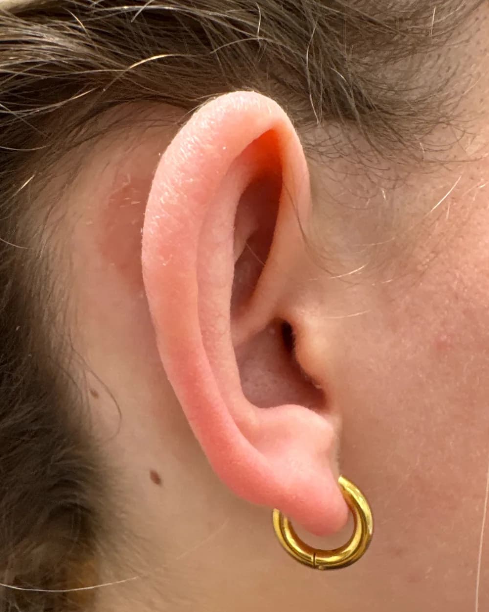 Right ear, from the side, before surgery