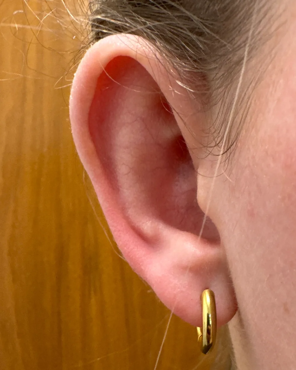 Right ear, from the front, before surgery