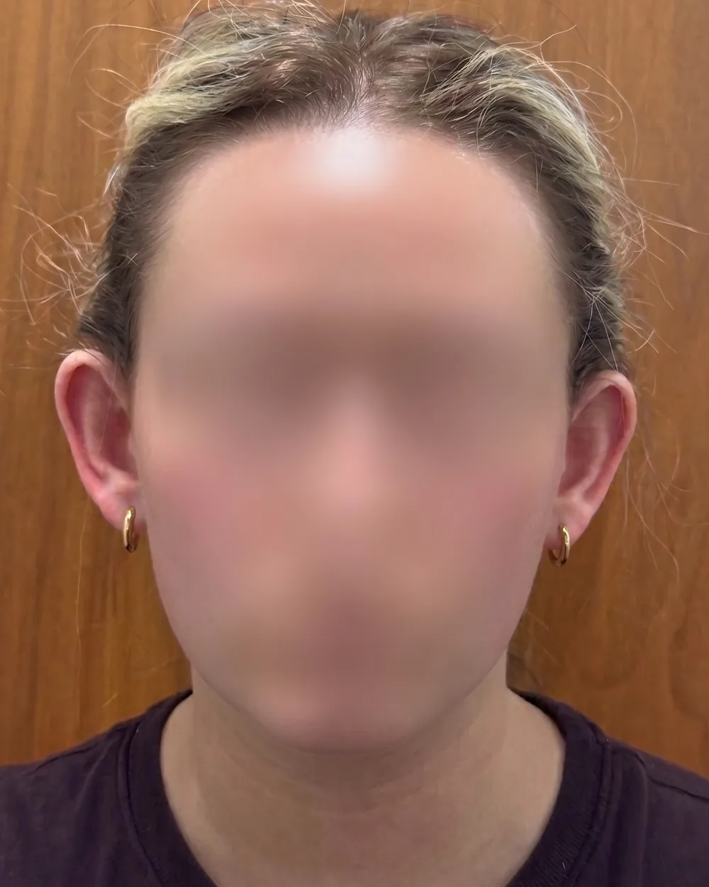 Face on, before surgery