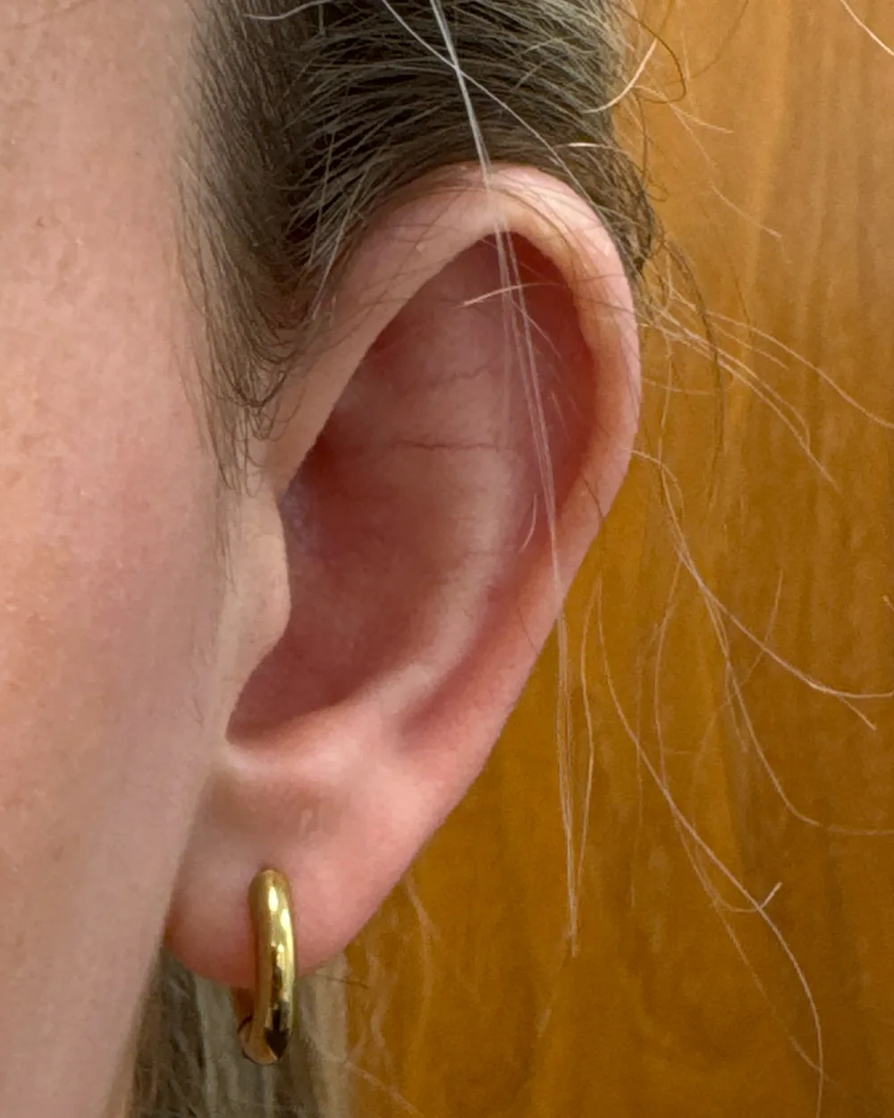 Left ear, from the front, before surgery