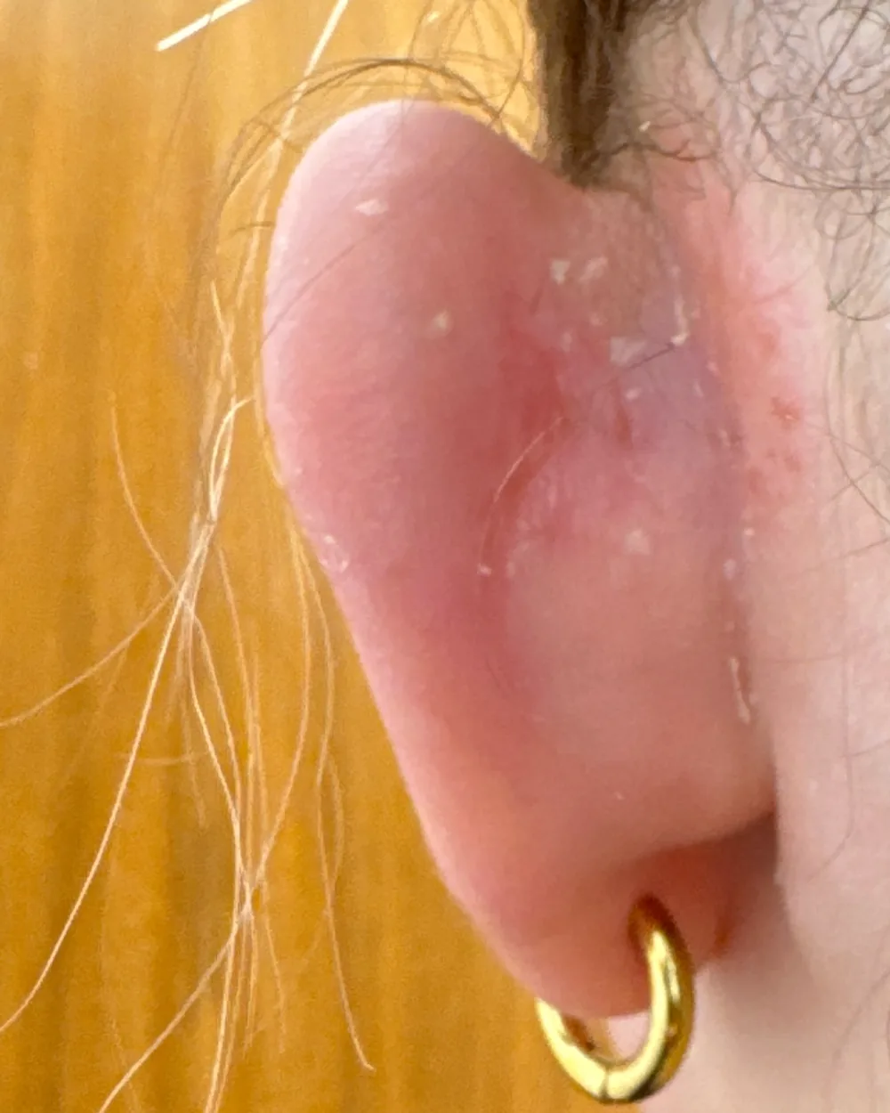 Behind the left ear, before surgery